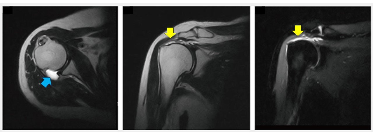 肩MRI.jpg